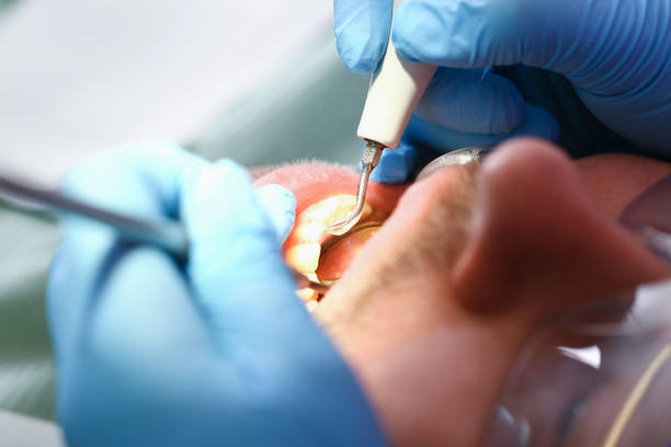 Best Emergency Dentist for Lost Fillings or Crowns in Frankston, TX